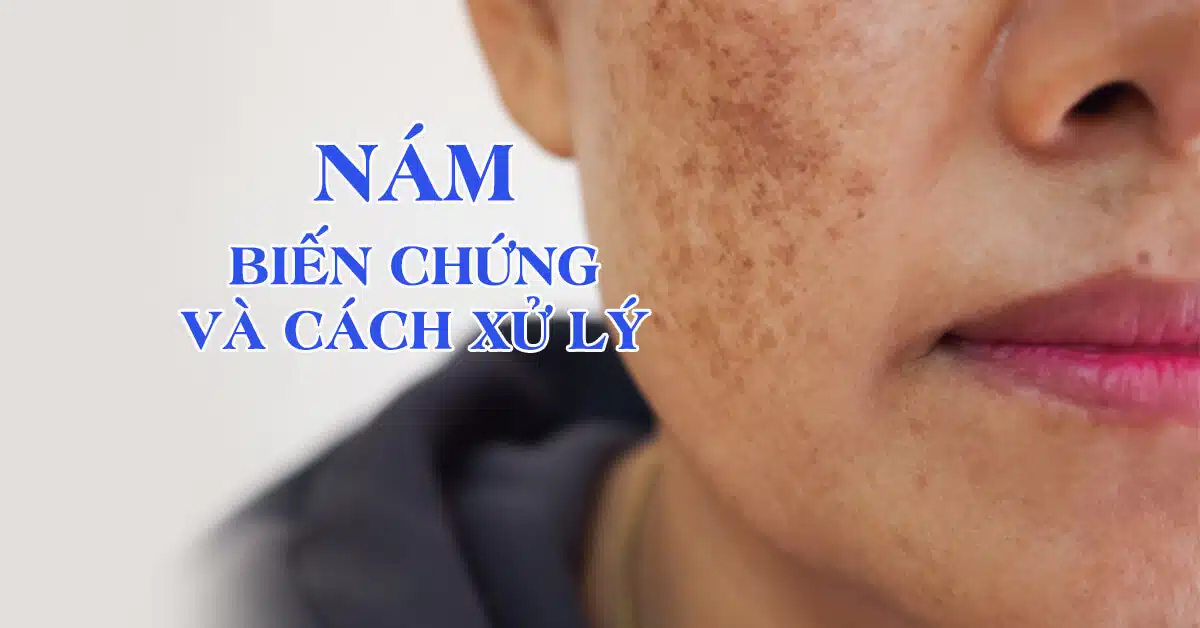 Nám biến chứng và cách xử lý hiệu quả nhất